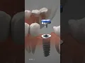 Dental Implant Procedure