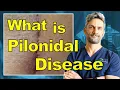 Pilonidal Cyst Disease Explained Why It Keeps Coming Back