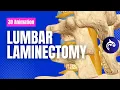 Lumbar Laminectomy - 3D Animation