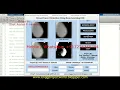 Breast Cancer Detection Deep Learning CNN Matlab Project With Source Code Breast Cancer Detection