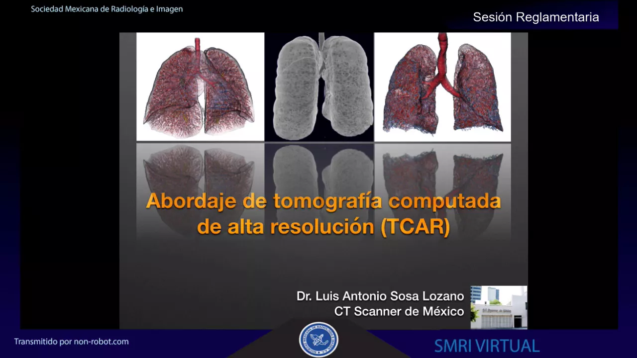 Abordaje en Tomografía Computada de Alta Resolución del Tórax