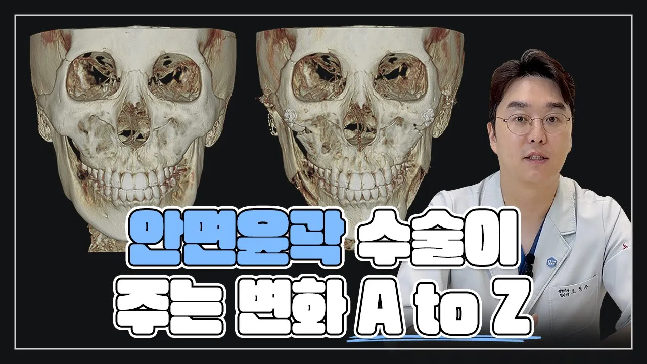 윤곽 3종, 4종 차이가 뭔가요? 안면윤곽 수술의 A부터 Z까지!