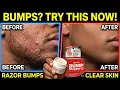 Razor Bumps Ruining Your Skin Try This