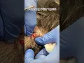 Download Lagu Popping Pilar Cysts | Dr. Derm