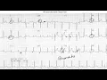 EKG - Normal Variants and Artifacts