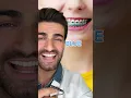Braces Color Guide