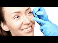 Tutorial How to Remove Milia