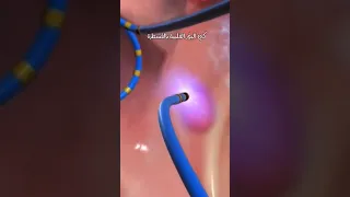 كي البؤر الكهربائية بالقلب 