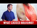 What Causes Bruising Without Trauma - Dr Berg