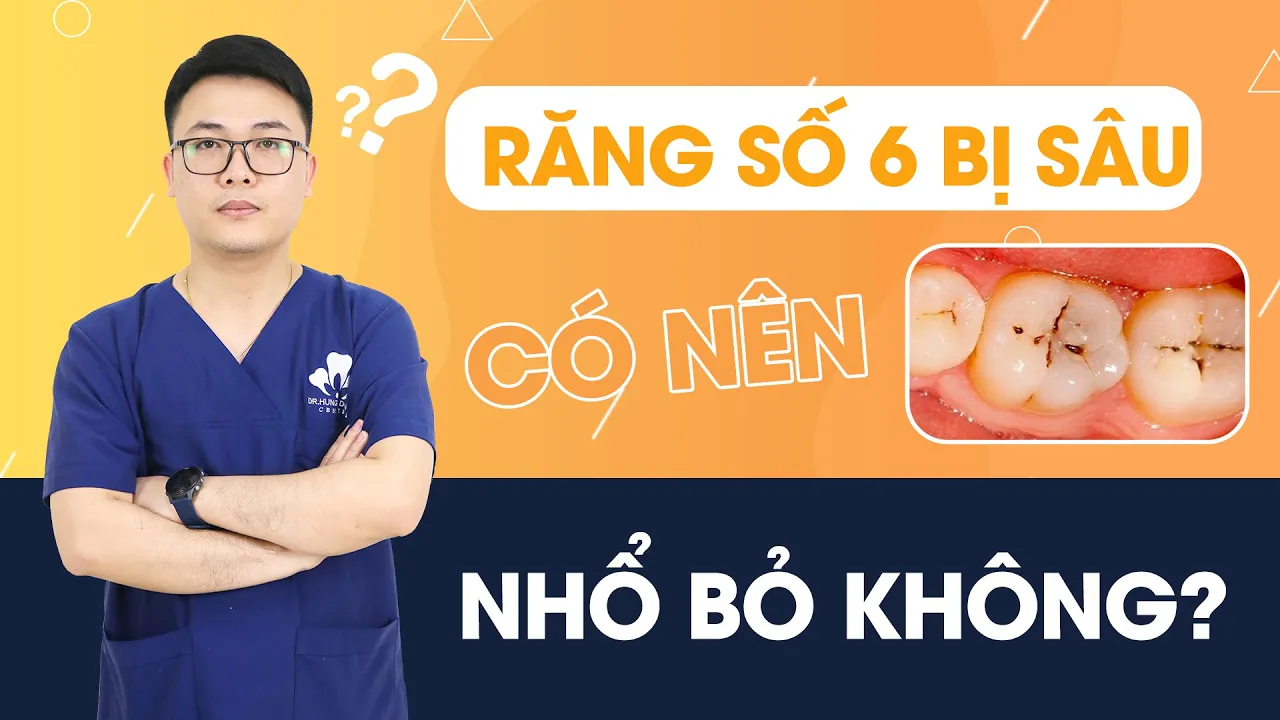 Outline Video Răng số 6 bị sâu có nên nhổ bỏ không | Nha Khoa Dr. Hưng