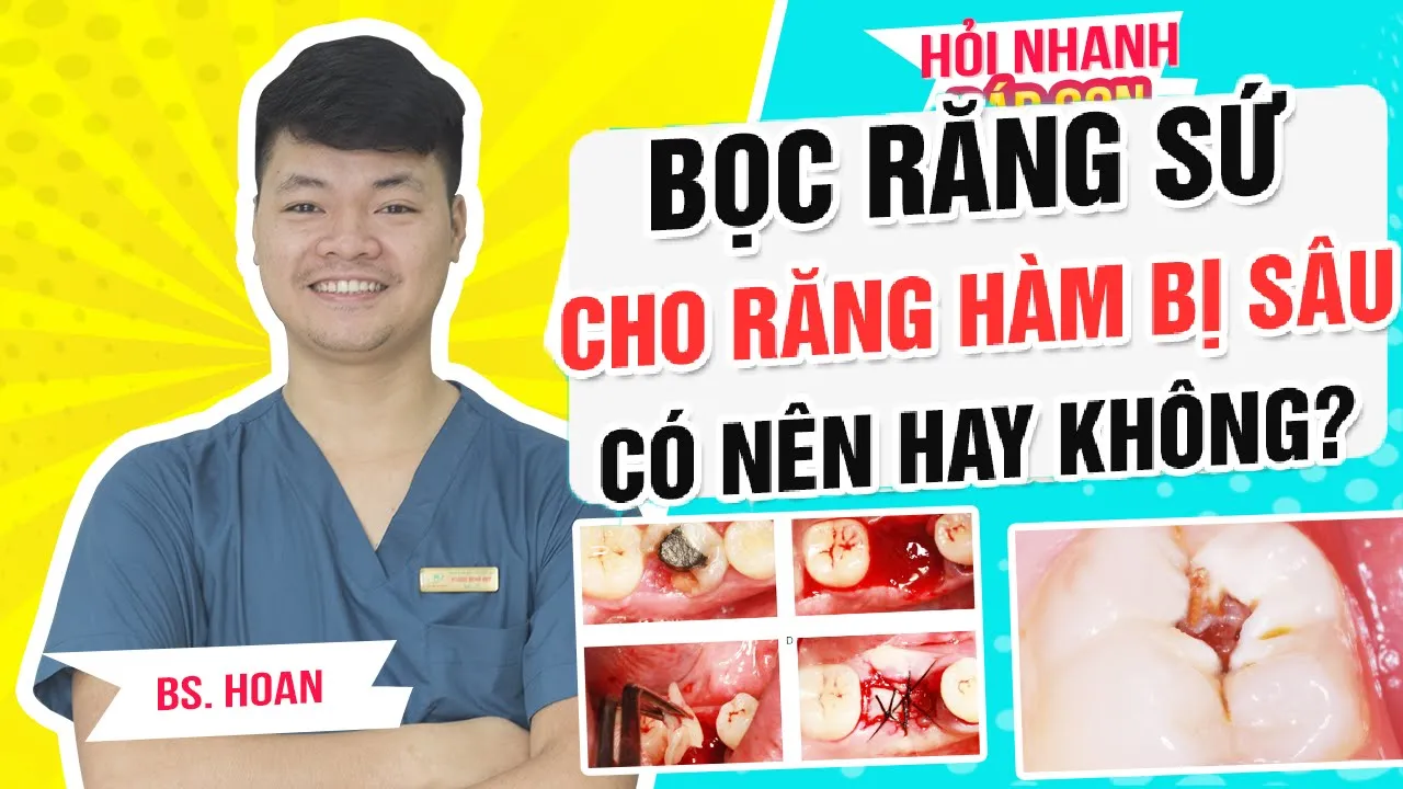 Outline Video Răng hàm bị sâu có cần bọc sứ hay không?