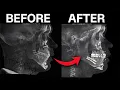 Why His First Jaw Surgery Failed And What Gunson Did Differently Origin Of Styx