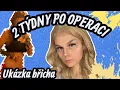2 týdny po Operaci! | jsem plná sajrajtu! 😵‍💫 | Jenny Rinn