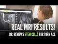 Doctor Reviews Stem Cell Results for Torn ACL - CPI Stem Cells