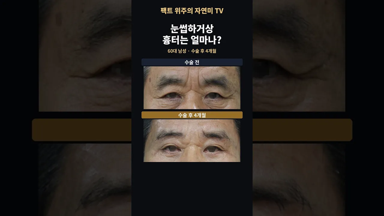 눈썹하거상 흉터, 4개월 뒤 모습은? 60대 남성 증례#눈썹하거상 #눈썹하거상흉터 #미간주름 #shorts #연세자연미