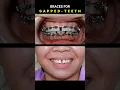 Download Lagu BRACES FOR GAPPED TEETH. 32 MONTHS DURATION #braces #orthodontist #dentist