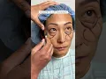 3 Weeks After Upper Lower Blepharoplasty with Dr Kami Parsa Quadfecta Lift