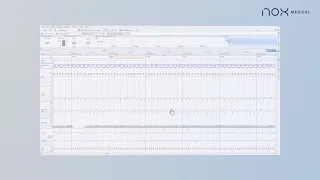 Total Sleep Time Tool in Noxturnal Software