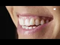 DSD Smile Makeover Facetas cerâmicas / Porcelain Veneers
