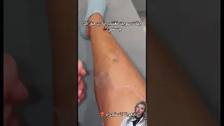 تقشير الجلد كامل للتخلص من مشاكل البشرة         دندنها