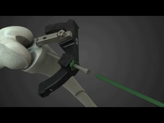 Tibial Nail Surgical Technique