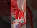 Brain Aneurysm Clipping 3D Animation