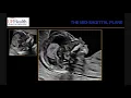 The Mid Sagittal Plane in the First Trimester Putting it all Together by Dr Reem S Abu-Rustum