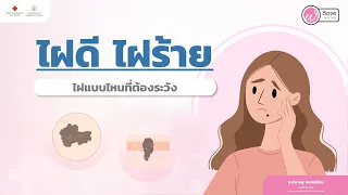  ไฝที่ไม่ปกติมีลักษณะอย่างไรบ้าง 