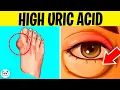 Download Lagu 7 Symptoms of High Uric Acid Levels In The Body | Gout Symptoms