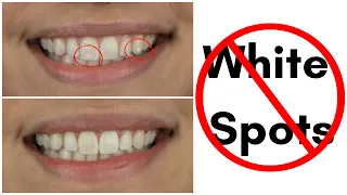 NEW PROCEDURE How to Reverse White Spots Lesions on Teeth