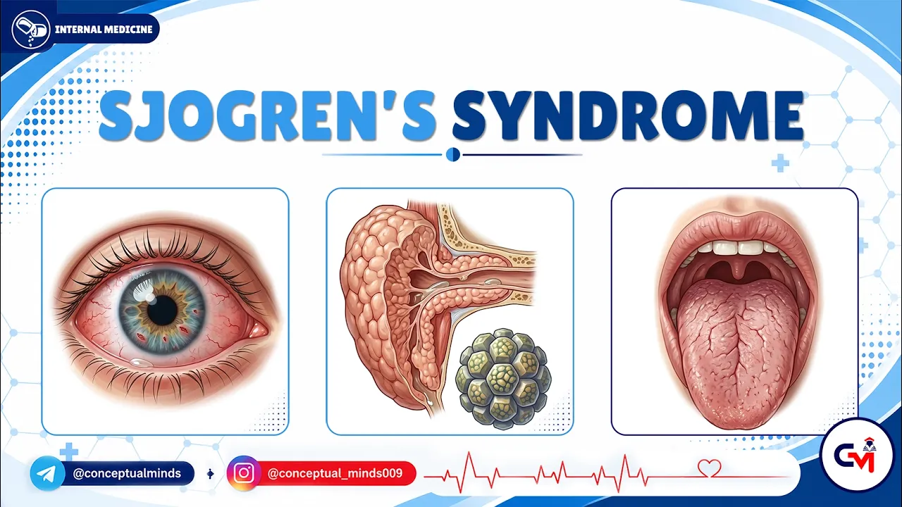 9. Sjögren's Syndrome | Autoimmune Dryness Explained with Clinical Insights