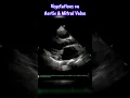 Download Lagu Infective Endocarditis invloving Mitral and Aortic Valve #heart #shorts #echocardiography