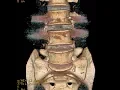 Lagu A Case of Double Failed Lumbar Fusion and Dangerously Misplaced Pedicle Screws