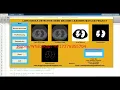 Lung Nodule Segmentation Using Machine Learning Lung Nodule Classification Using Matlab Project Code