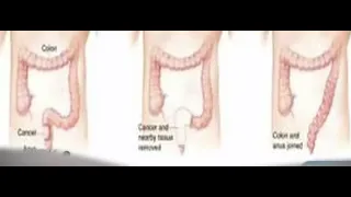 ازاى يتم توصيل القولون للمستقيم بدون فتحة اخراج بالبطن دكتور علي احمد شفيق 