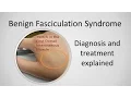 Benign Fasciculation Syndrome Causes and Treatment