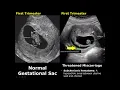Uterus Ultrasound Normal Pregnancy Vs Miscarriage Image Appearances Intrauterine Pregnancy USG