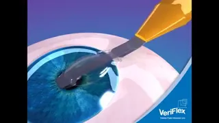 زراعة عدسة داخل العين                     دندنها