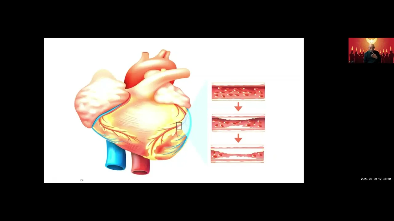 Heart Attack, Brain Aneurysm and Stroke by Reggie Lee