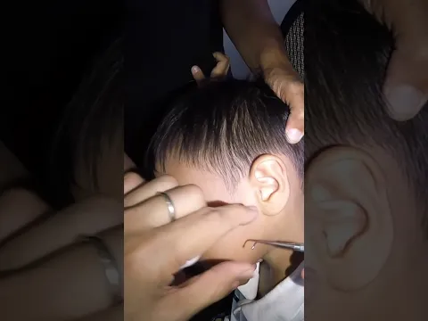 Styrofoam STUCK inside Boy's Ear REMOVED