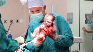Live Caesarean Birth Of Twins Watch The Father S Face 