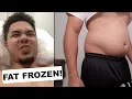 I HAD MY FAT FROZEN OFF Coolsculpting at LaserAway