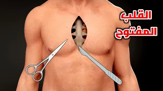 شاهد عملية القلب المفتوح Heart Bypass Surgery Step By Step 
