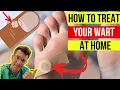 Doctor explains how to treat WARTS at home plus when to seek medical attention