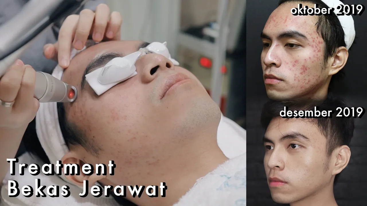 
          
          
          
            
            KUPAS TUNTAS! TREATMENT BEKAS JERAWAT di Klinik Dermaster +TANAM BENANG
          
        . 