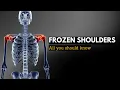 Frozen Shoulder, Causes, Signs and Symptoms, Diagnosis and Treatment.