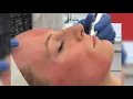 Microneedling at SmarterSkin Dermatology in Tribeca NYC