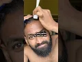 Download Lagu Derma rolling methods #hair #hairlosstreatment #dermaroller #dermarolling
