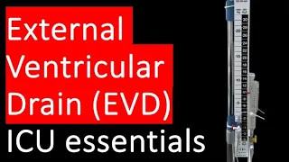External Ventricular Drain EVD ICP monitoring and CSF drainage