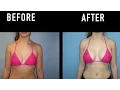 Natural looking breast augmentation surgery